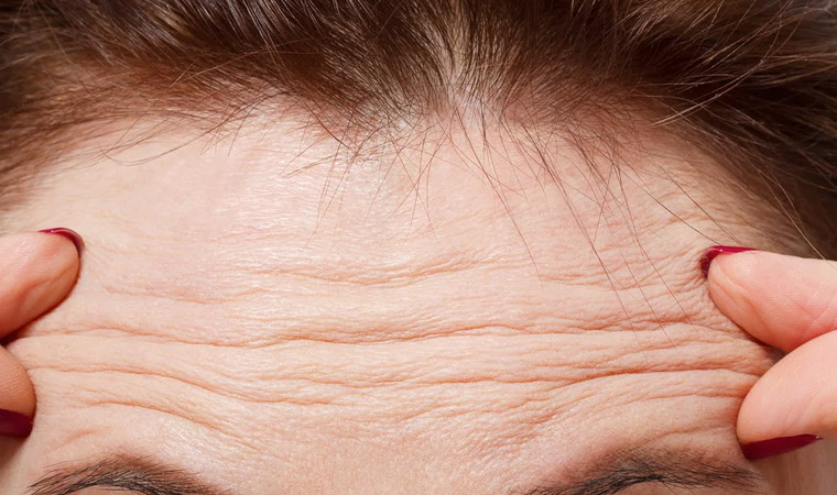 Forehead Wrinkes in Gamboa Dental Group