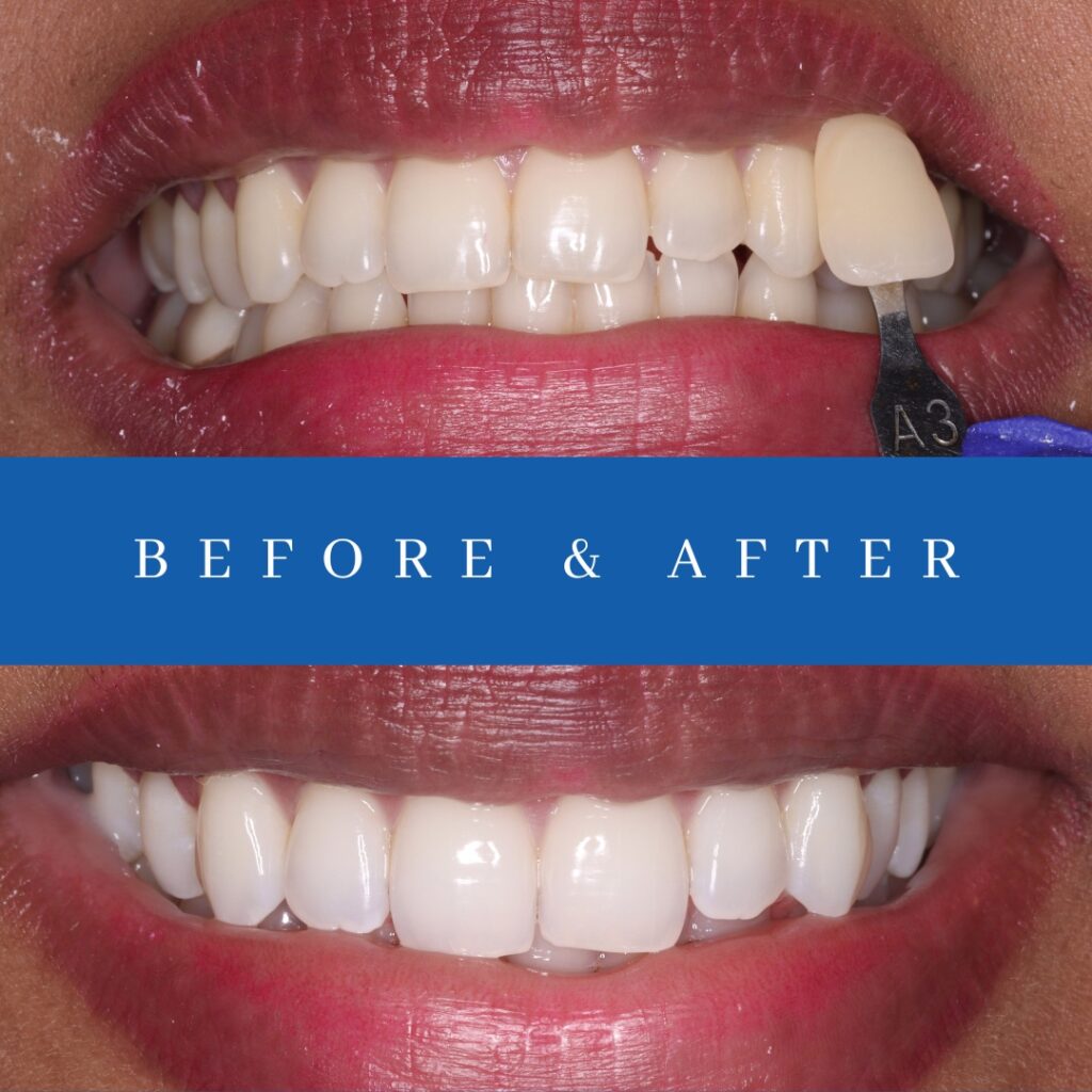 before after zoom whitenining doral