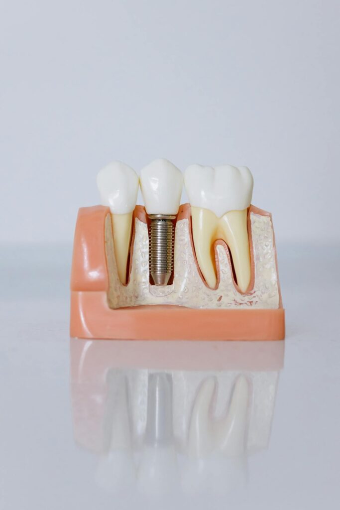 dental implants